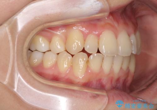 八重歯の抜歯矯正 補助装置を用いたインビザライン矯正の治療中