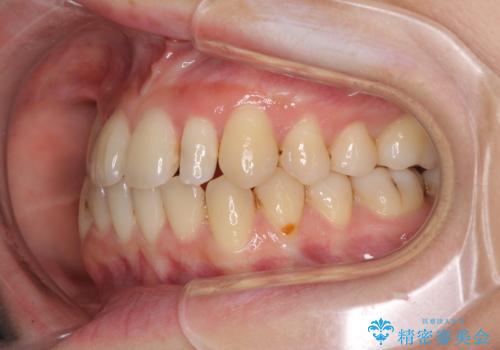 八重歯の抜歯矯正 補助装置を用いたインビザライン矯正の治療中