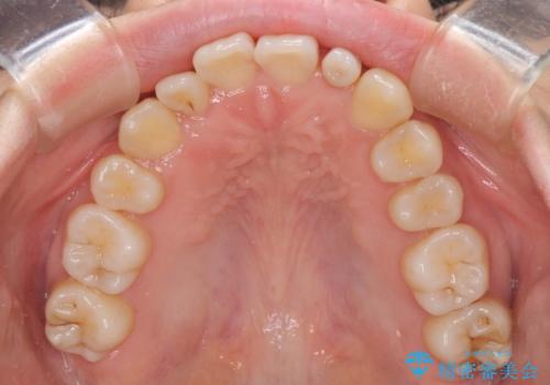 八重歯の抜歯矯正 補助装置を用いたインビザライン矯正の治療中