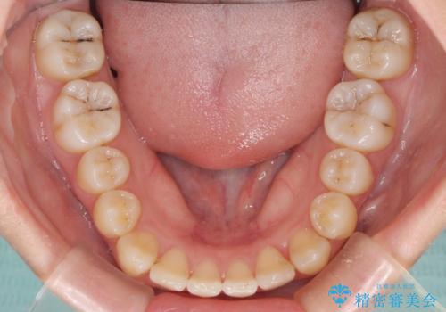 八重歯の抜歯矯正 補助装置を用いたインビザライン矯正の治療中