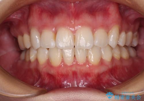 上顎の八重歯と下顎前歯の欠損　ワイヤー装置による抜歯矯正の症例 治療後