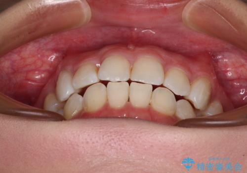 上顎の八重歯と下顎前歯の欠損 ワイヤー装置による抜歯矯正の治療後