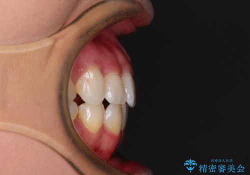 上顎の八重歯と下顎前歯の欠損 ワイヤー装置による抜歯矯正の治療後