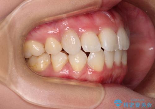 上顎の八重歯と下顎前歯の欠損 ワイヤー装置による抜歯矯正の治療後