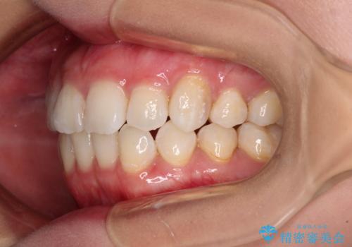 上顎の八重歯と下顎前歯の欠損 ワイヤー装置による抜歯矯正の治療後