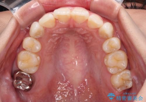 上顎の八重歯と下顎前歯の欠損 ワイヤー装置による抜歯矯正の治療後