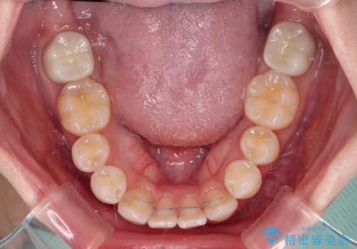 上顎の八重歯と下顎前歯の欠損　ワイヤー装置による抜歯矯正の治療後