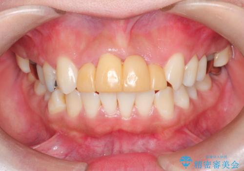 3年間仮歯 前歯セラミックブリッジの治療前