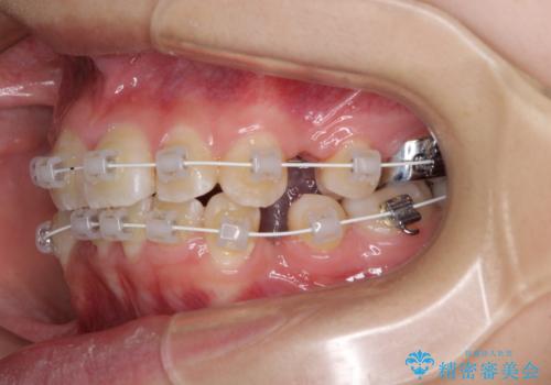 八重歯で正中が右にずれている ワイヤー装置での抜歯矯正で正中位置を改善の治療中