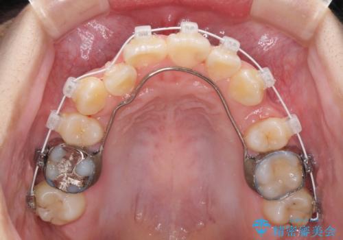 八重歯で正中が右にずれている ワイヤー装置での抜歯矯正で正中位置を改善の治療中
