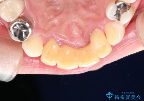 3年間仮歯 前歯セラミックブリッジの治療前