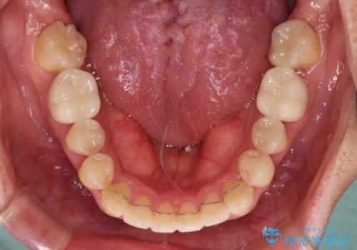 咬み合わせが気になる　ワイヤー矯正による咬み合わせ改善と奥歯のセラミック治療の治療後