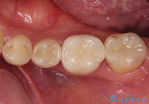 咬み合わせが気になる　ワイヤー矯正による咬み合わせ改善と奥歯のセラミック治療の治療後