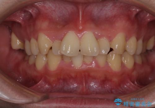 強い咬み込みですり減った前歯　デコボコを抜歯矯正で整えるの症例 治療前