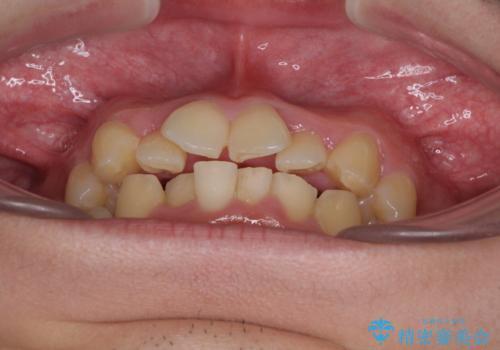 強い咬み込みですり減った前歯 デコボコを抜歯矯正で整えるの治療前