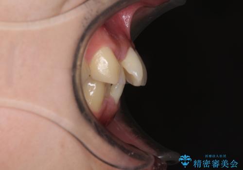 強い咬み込みですり減った前歯 デコボコを抜歯矯正で整えるの治療前