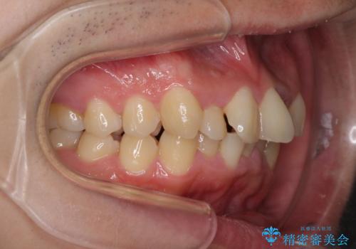 強い咬み込みですり減った前歯 デコボコを抜歯矯正で整えるの治療前