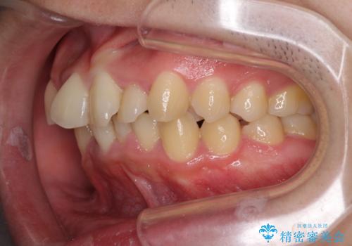 強い咬み込みですり減った前歯　デコボコを抜歯矯正で整えるの治療前