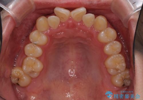 強い咬み込みですり減った前歯 デコボコを抜歯矯正で整えるの治療前