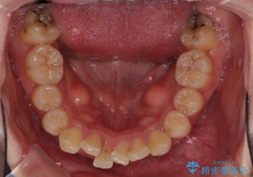 強い咬み込みですり減った前歯 デコボコを抜歯矯正で整えるの治療前