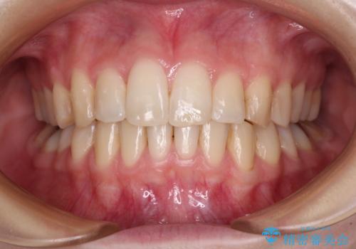 短期間での治療 急速拡大装置を併用したワイヤー装置による矯正治療の症例 治療後