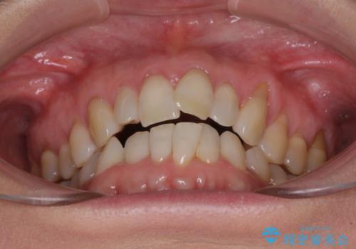 前歯のスペースが気になる インビザラインによる矯正治療の治療前