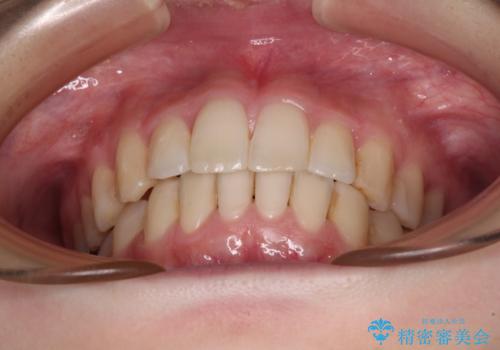 短期間での治療 急速拡大装置を併用したワイヤー装置による矯正治療の治療後