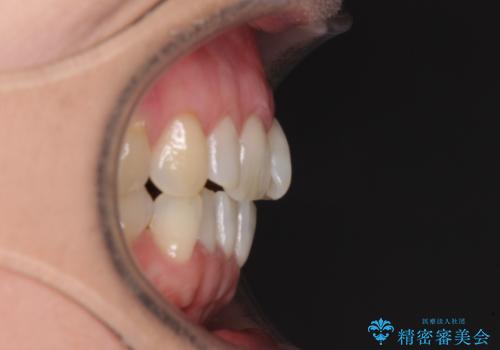 前歯のスペースが気になる インビザラインによる矯正治療の治療前