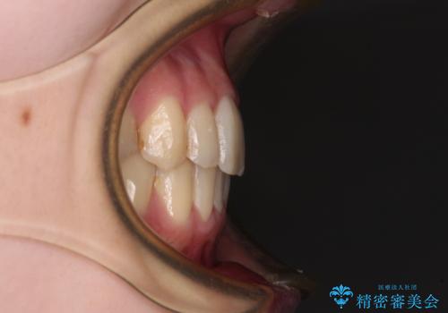 短期間での治療 急速拡大装置を併用したワイヤー装置による矯正治療の治療後