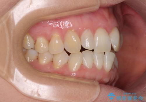 前歯のスペースが気になる インビザラインによる矯正治療の治療前