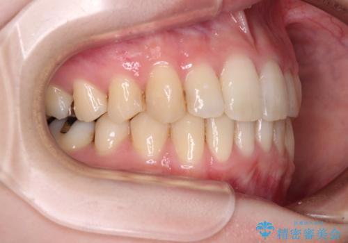 短期間での治療 急速拡大装置を併用したワイヤー装置による矯正治療の治療後