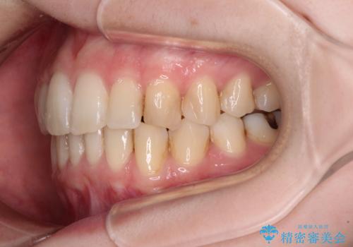 短期間での治療 急速拡大装置を併用したワイヤー装置による矯正治療の治療後