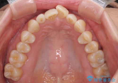 前歯のスペースが気になる インビザラインによる矯正治療の治療前