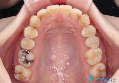 短期間での治療 急速拡大装置を併用したワイヤー装置による矯正治療の治療後