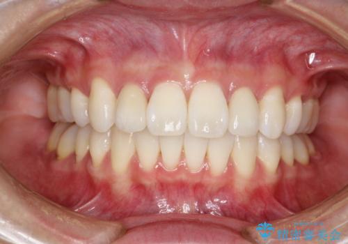 ワイヤー矯正とオールセラミックの組み合わせ治療の治療後