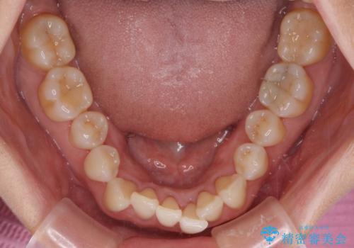 前歯のスペースが気になる インビザラインによる矯正治療の治療前