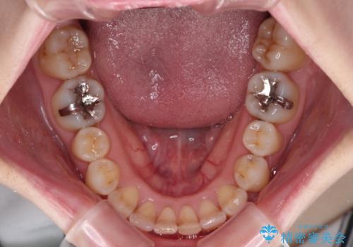短期間での治療 急速拡大装置を併用したワイヤー装置による矯正治療の治療後