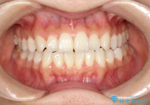 軽度の前歯のガタガタをインビザラインでの目立たない矯正の症例 治療前