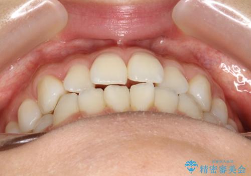 軽度の前歯のガタガタをインビザラインでの目立たない矯正の治療前