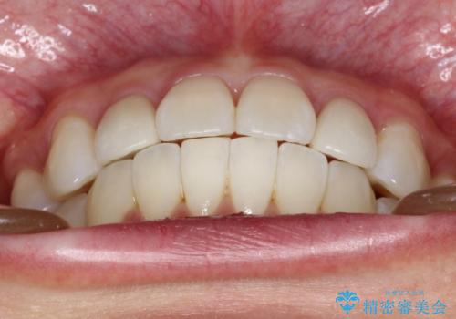 ワイヤー矯正とオールセラミックの組み合わせ治療の治療後