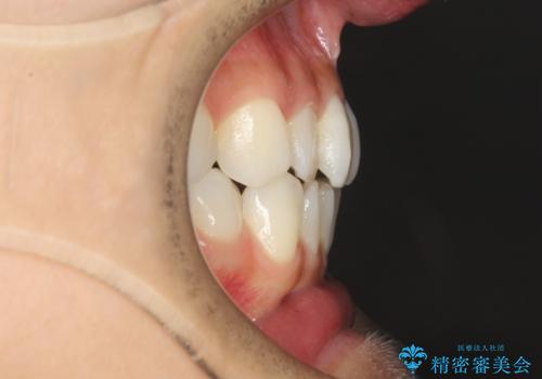 軽度の前歯のガタガタをインビザラインでの目立たない矯正の治療前