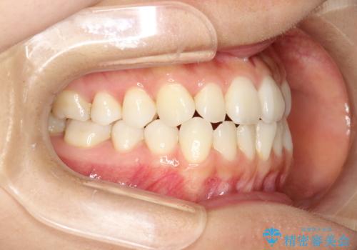 軽度の前歯のガタガタをインビザラインでの目立たない矯正の治療前