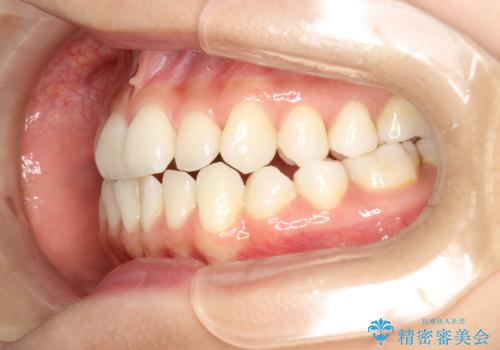 軽度の前歯のガタガタをインビザラインでの目立たない矯正の治療前