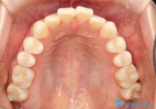 軽度の前歯のガタガタをインビザラインでの目立たない矯正の治療前