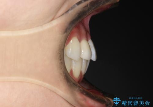 ワイヤー矯正とオールセラミックの組み合わせ治療の治療後
