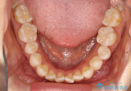 軽度の前歯のガタガタをインビザラインでの目立たない矯正の治療前