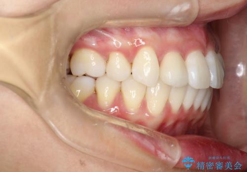 ワイヤー矯正とオールセラミックの組み合わせ治療の治療後