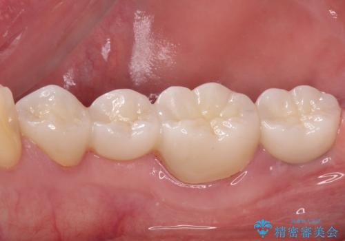 割れてしまった奥歯をインプラントで　気になる銀歯もセラミッククラウンで審美的にの治療後