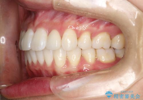 ワイヤー矯正とオールセラミックの組み合わせ治療の治療後