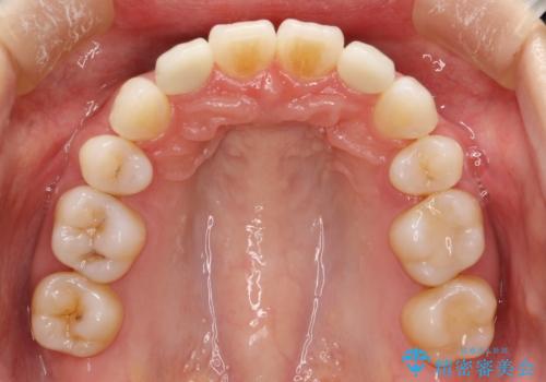 ワイヤー矯正とオールセラミックの組み合わせ治療の治療後